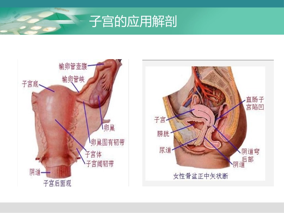 经腹广泛全子宫盆腔淋巴结清扫业务学习_第3页