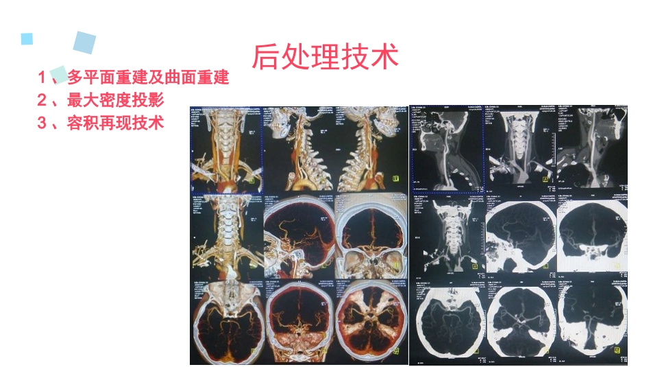 颈部血管CTA_第3页