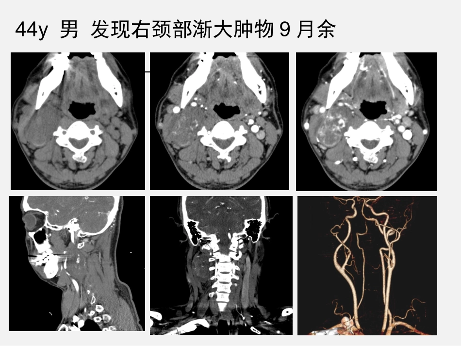 颈动脉体瘤影像学诊疗_第1页