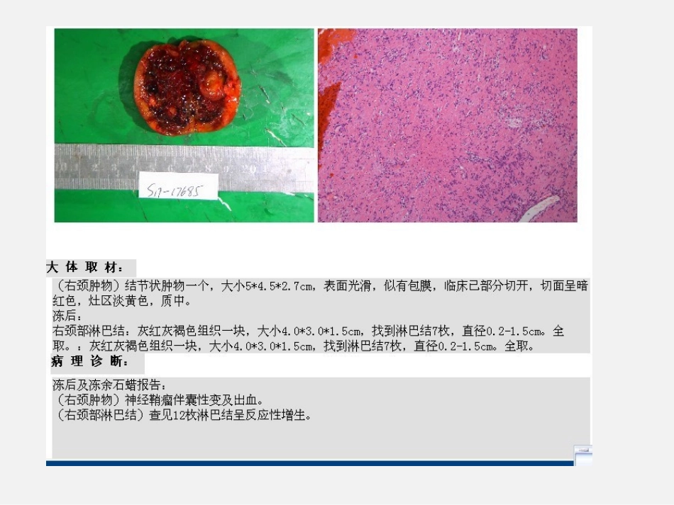 颈动脉体瘤影像学诊疗_第3页
