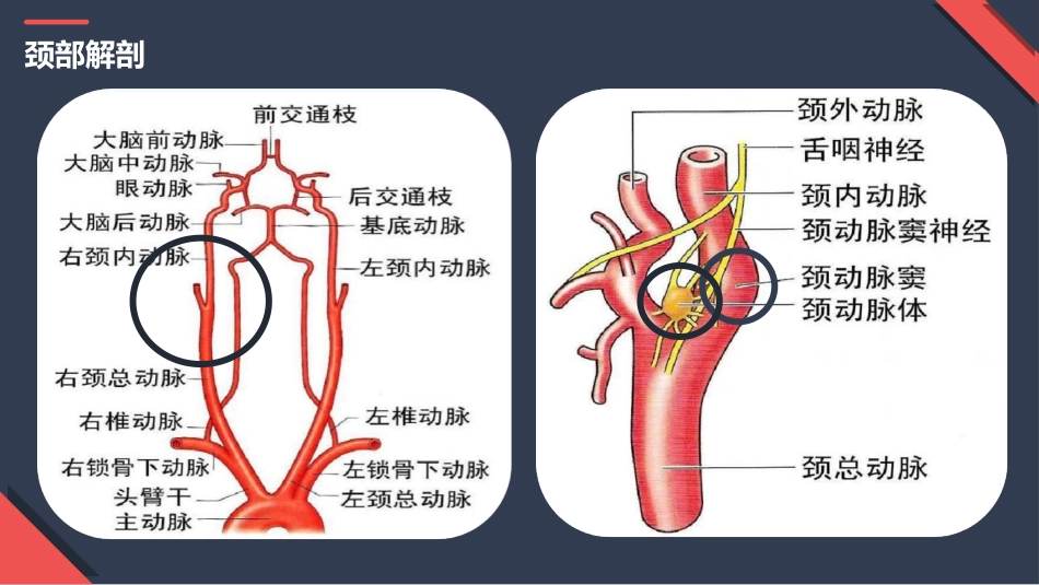 颈动脉狭窄的护理_第3页