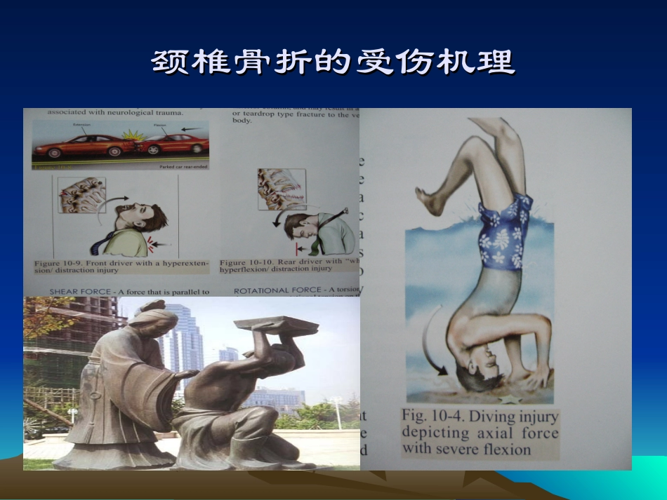 颈椎骨折和脱位_第3页