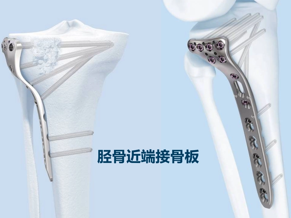 胫骨近段解决方案_第1页