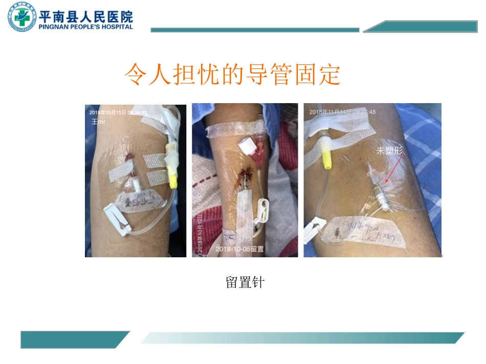 静疗培训常见各种导管的固定方法_第3页