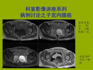 科室影像讲座之子宫内膜癌的MRI影像表现及分期