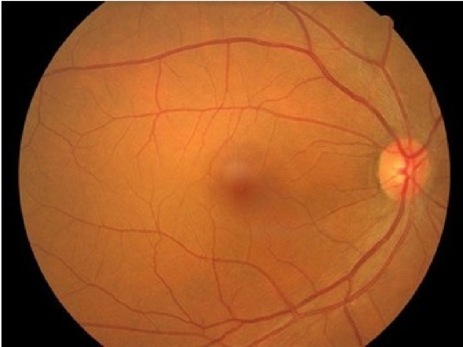 科学矫正近视关注孩子眼健康_第2页
