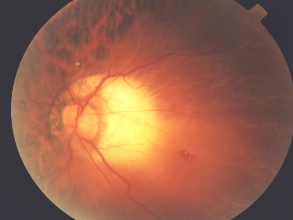 科学矫正近视关注孩子眼健康_第3页