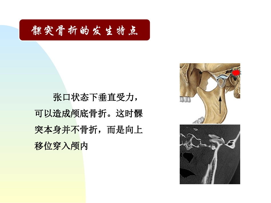 口外精品医学课件髁突骨折_第3页