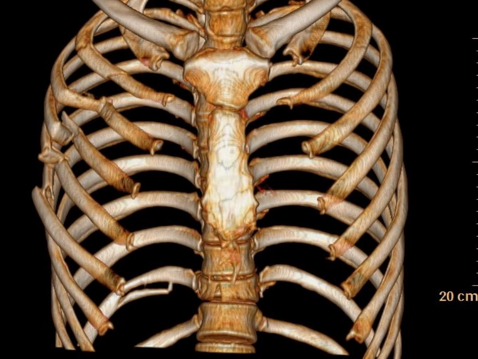 肋骨骨折的手术治疗课件_第3页