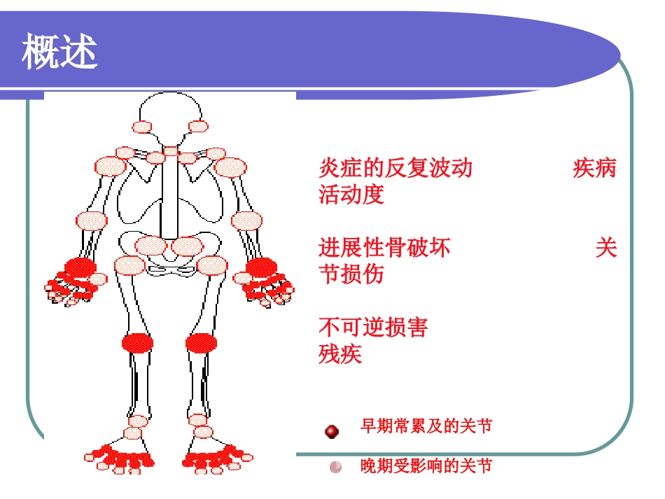 类风湿关节炎_第2页