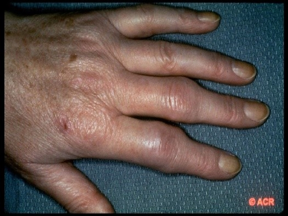 类风湿关节炎的中医治疗_第2页