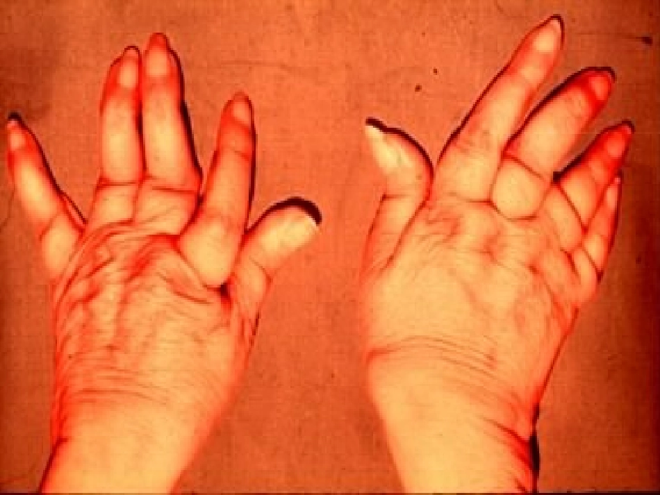 类风湿关节炎的中医治疗_第3页