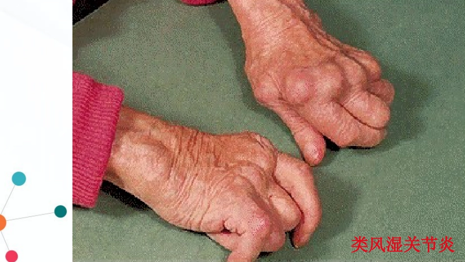 类风湿性关节炎_第2页