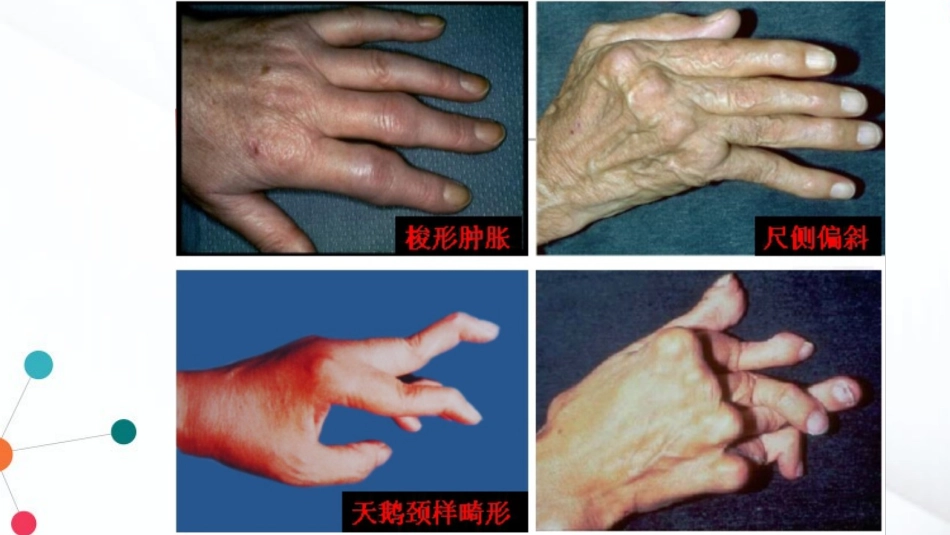 类风湿性关节炎_第3页