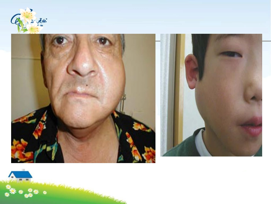 流行性腮腺炎课件描述_第1页