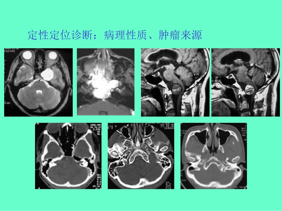 颅底肿瘤的影像学改变和治疗考虑_第3页