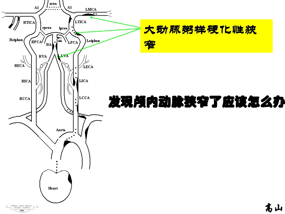 颅内动脉粥样硬化性狭窄的治疗_第2页