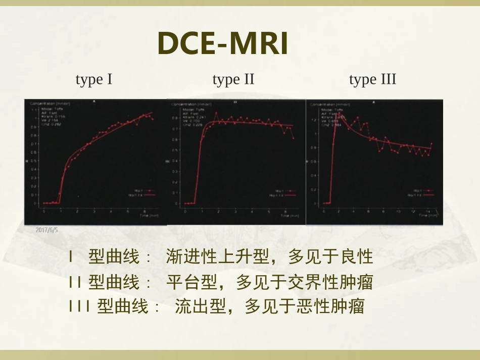 卵巢少见肿瘤的影像诊疗_第3页