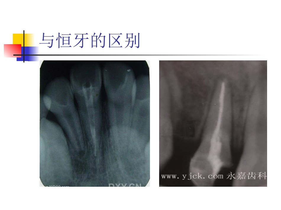 年轻恒牙疾病的治疗_第3页