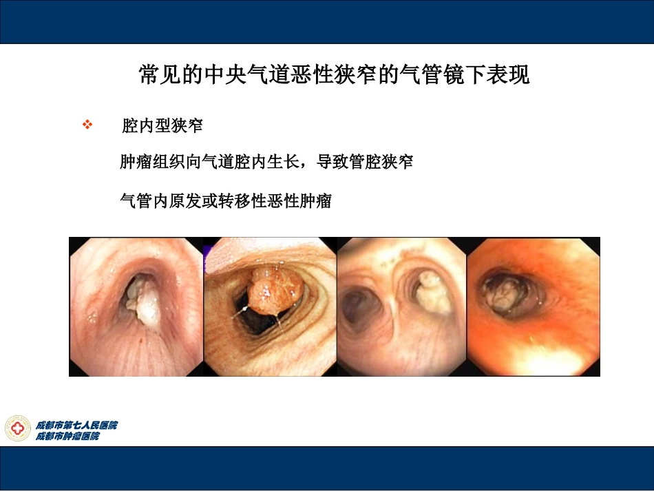 气道支架陈维永_第3页