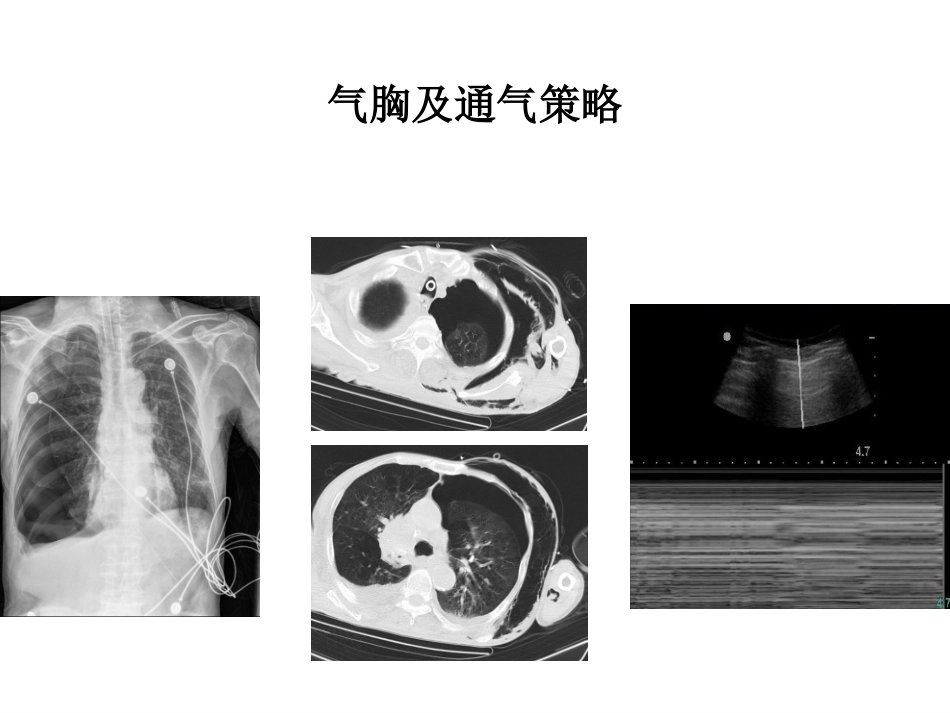 气胸及通气策略_第1页