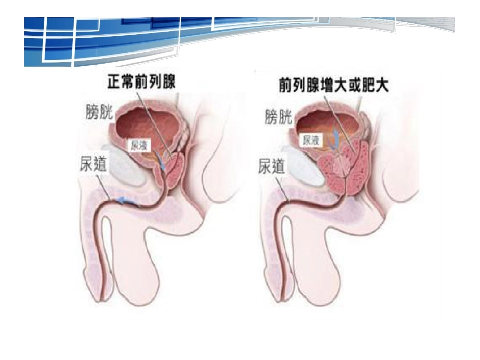 前列腺术后护理_第3页