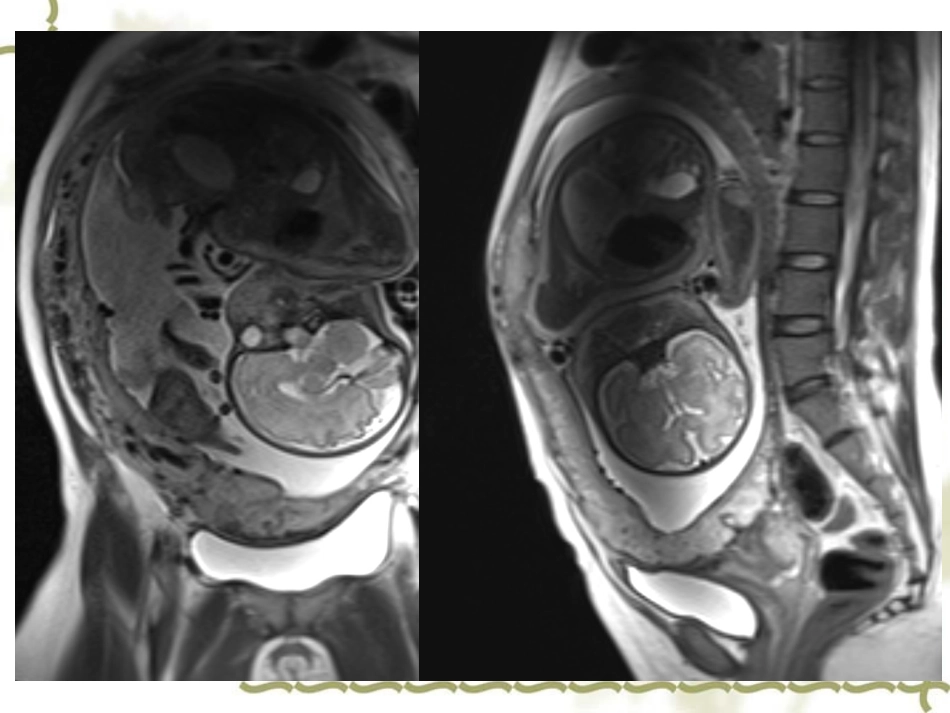 前置胎盘和胎盘植入_第3页
