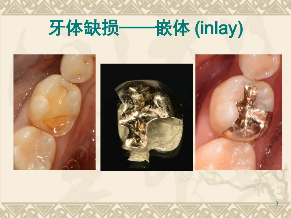 嵌体和高嵌体教学课件_第3页
