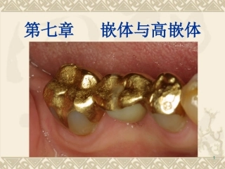 嵌体和高嵌体教学课件