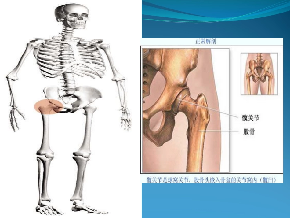 人工髋关节置换术护理_第3页