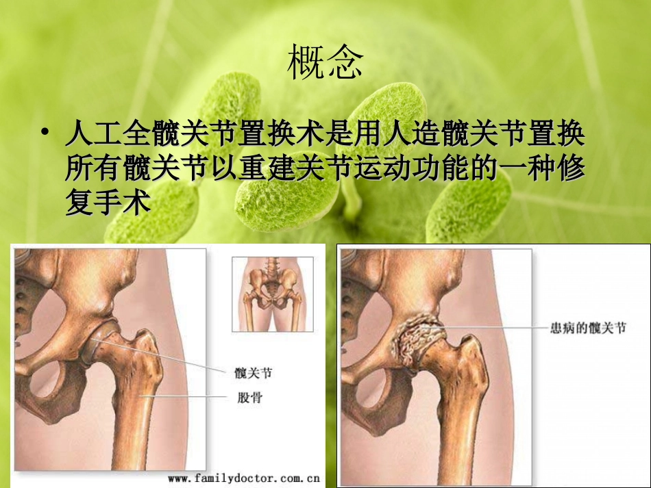 人工全髋关节置换术_第3页