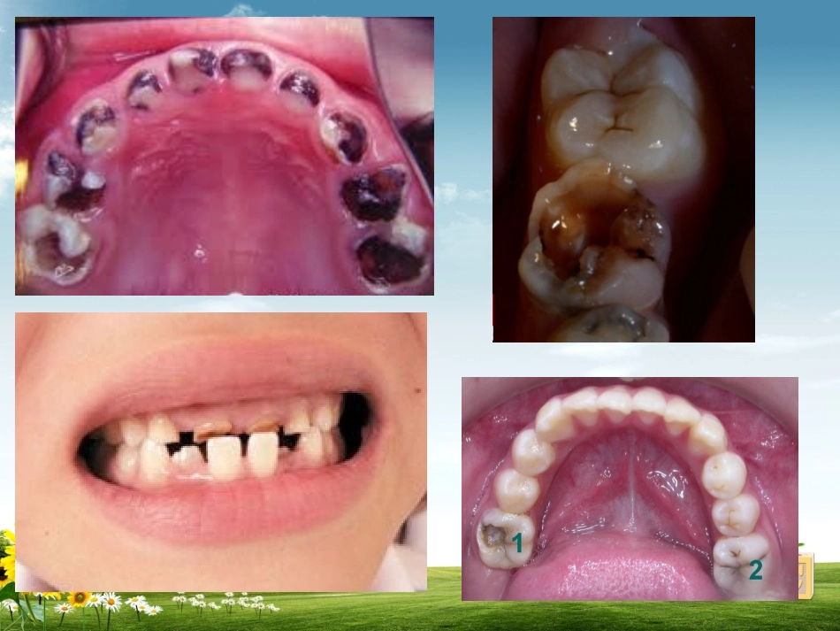 乳牙及年轻恒牙的龋病及治疗_第3页