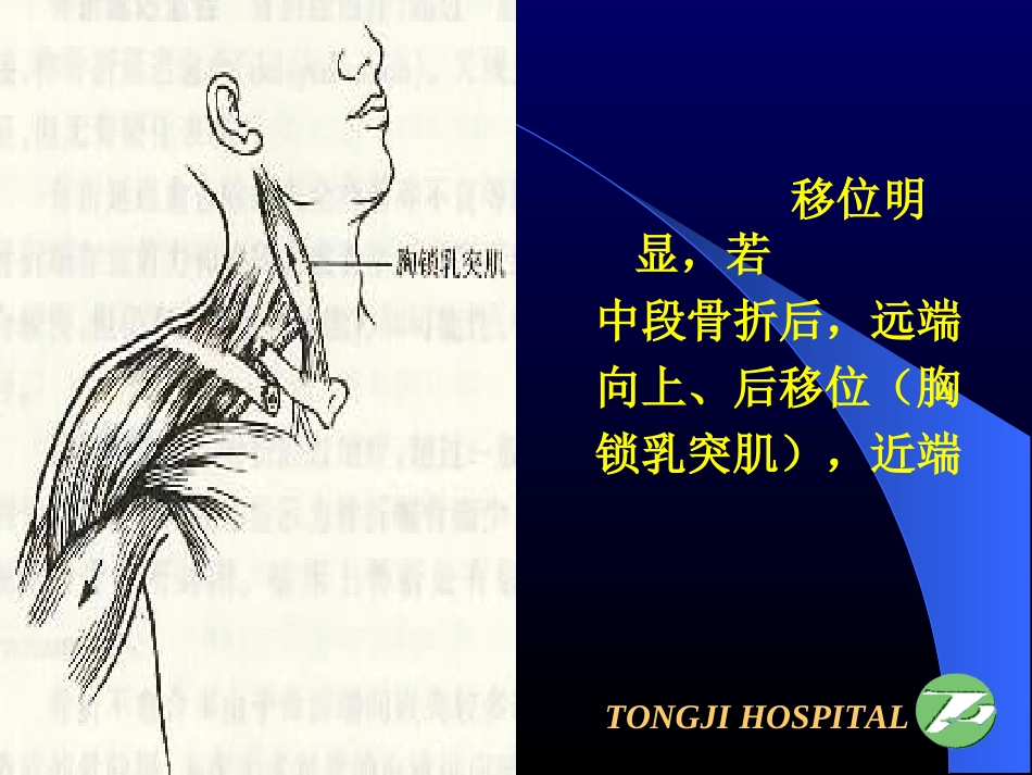 上肢骨折关节损伤_第3页