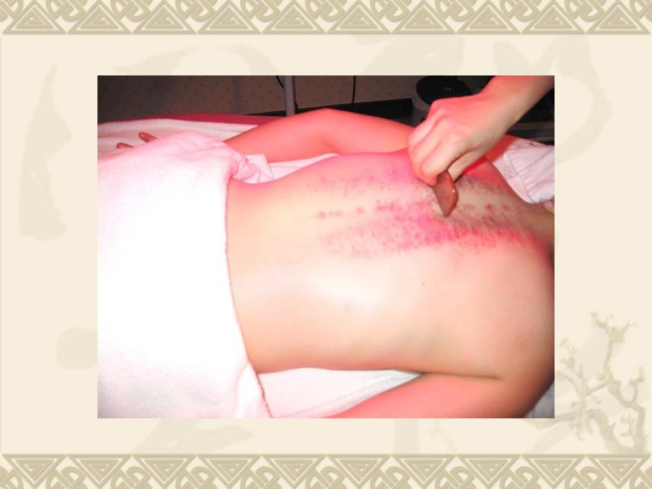 社区中医药适宜技术培训刮痧罐灸耳穴_第3页