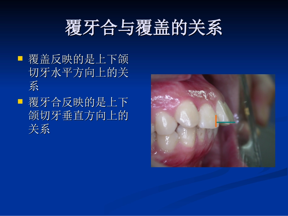深覆牙合深覆盖_第3页