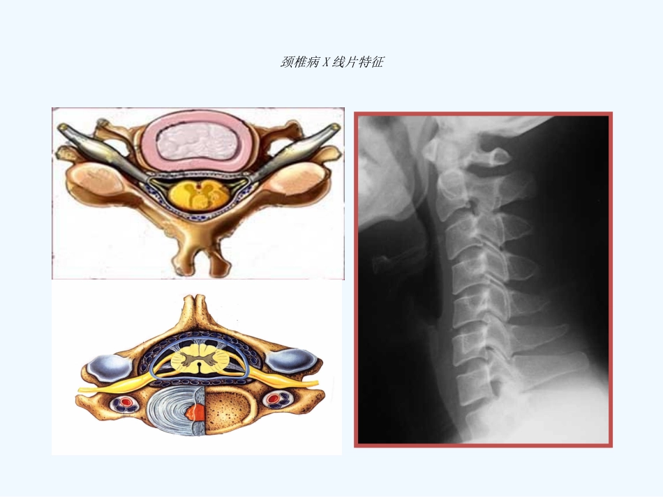 神经根性颈椎病_第3页