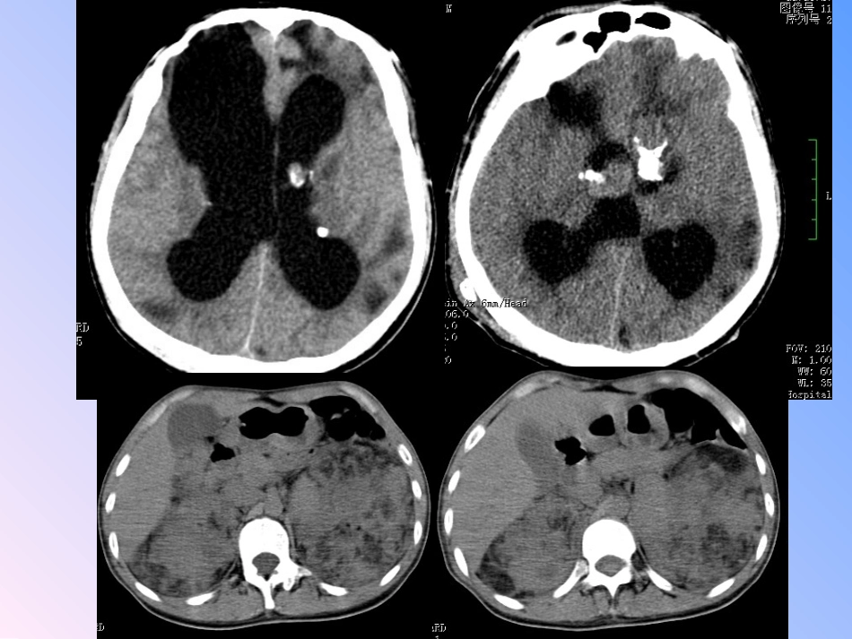 神经皮肤综合征_第3页