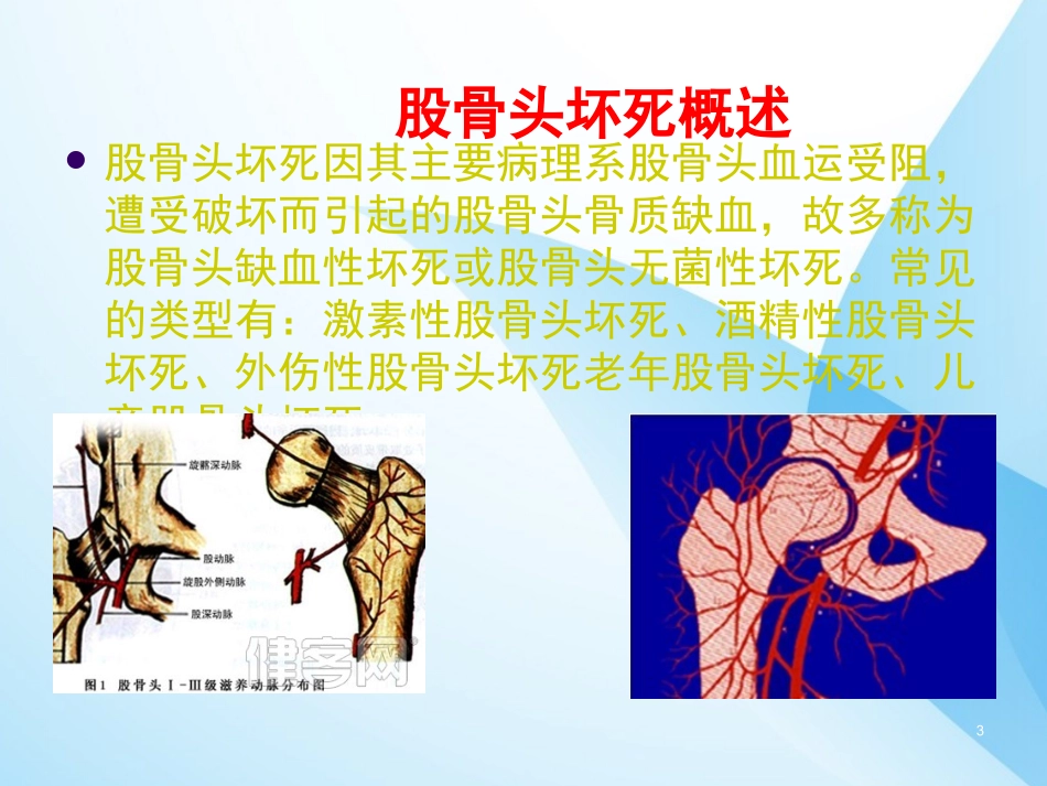 双侧股骨头坏死课件_第3页