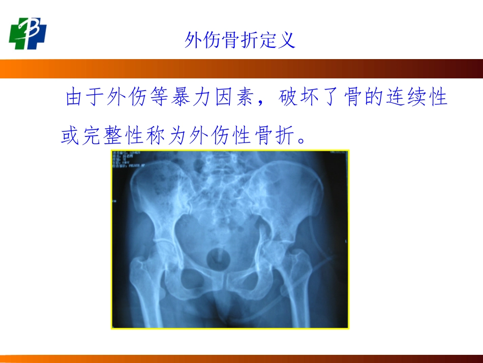 四肢骨折现场急救外固定技术_第3页