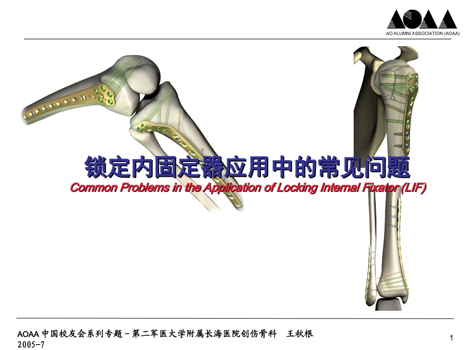 锁定内固定器应用中及内固定物取出的常见问题_第1页