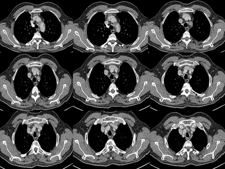 锁骨下动脉窃血综合征详解_第3页