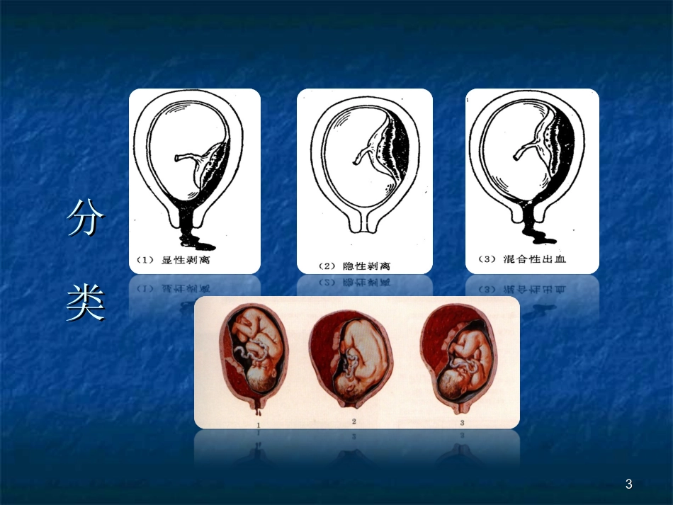 胎盘早剥的观察及护理课件_第3页