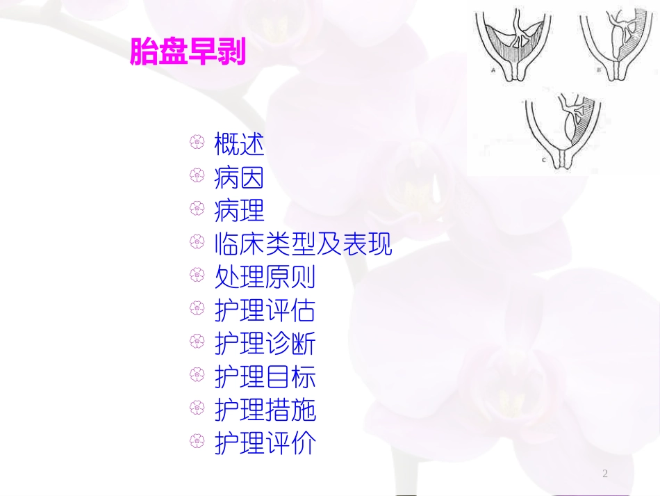 胎盘早剥护理医学课件_第2页