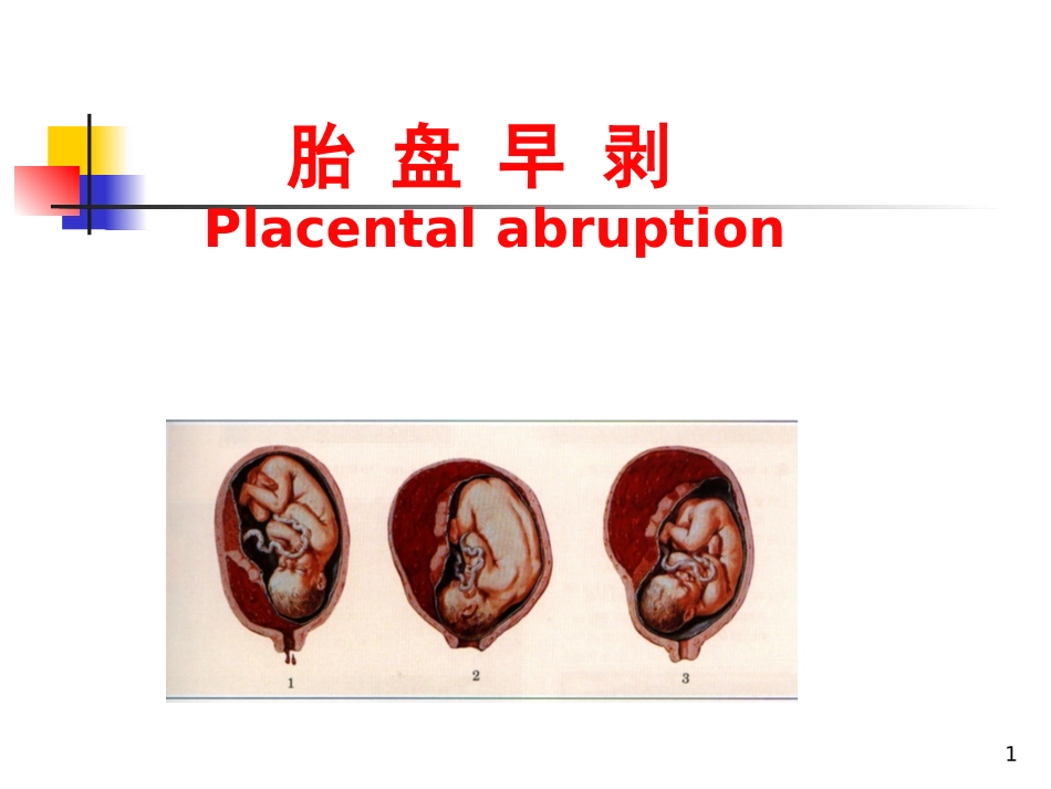 胎盘早剥疾病查房_第1页