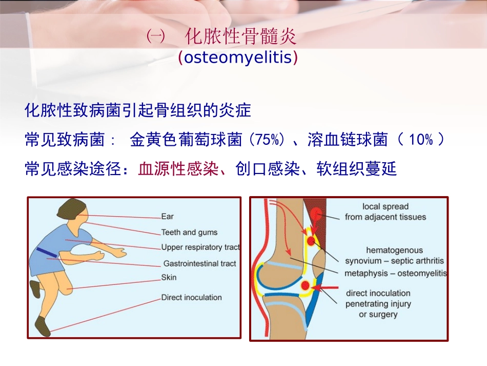 外科学课件骨和关节化脓性感染_第3页