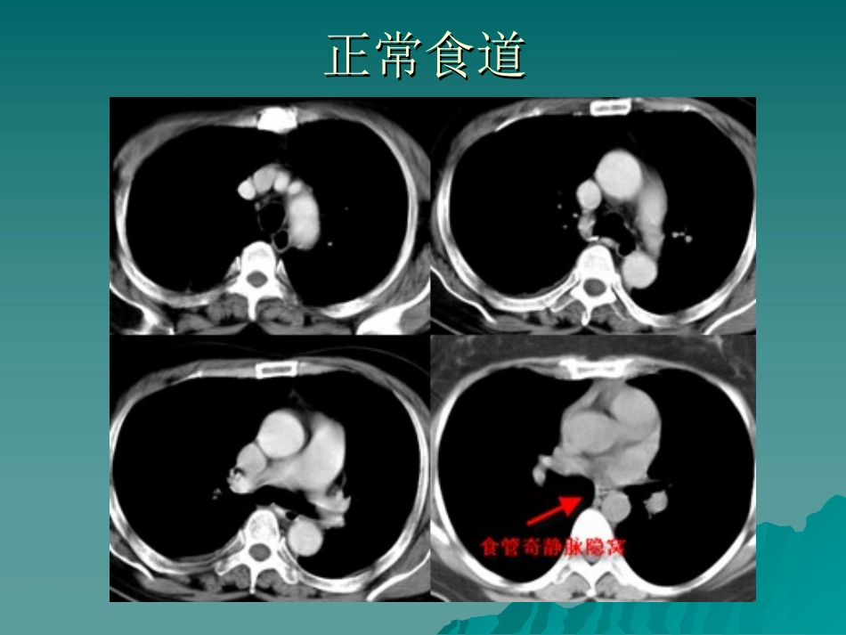 胃肠道病变CT诊疗_第2页