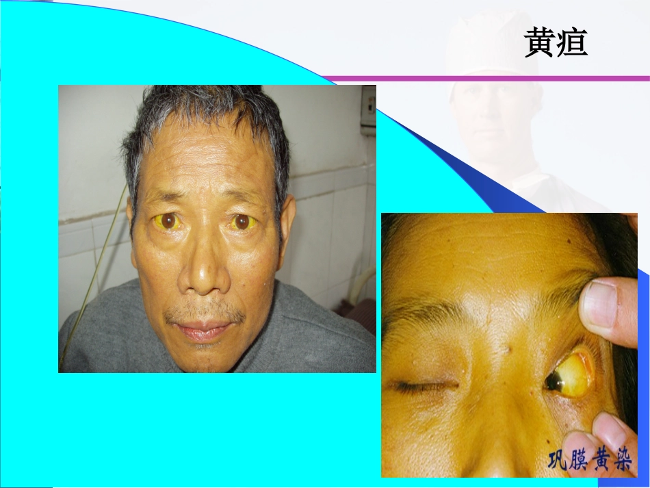 西医诊疗学黄疸_第3页