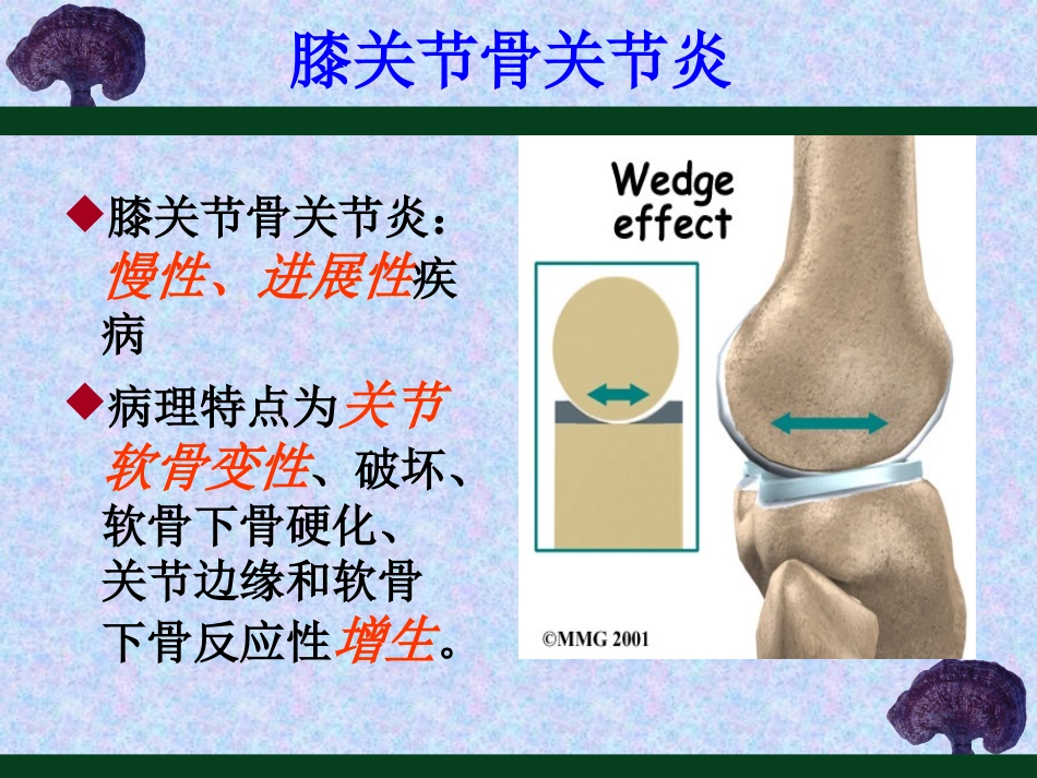 膝骨关节炎的防治_第2页