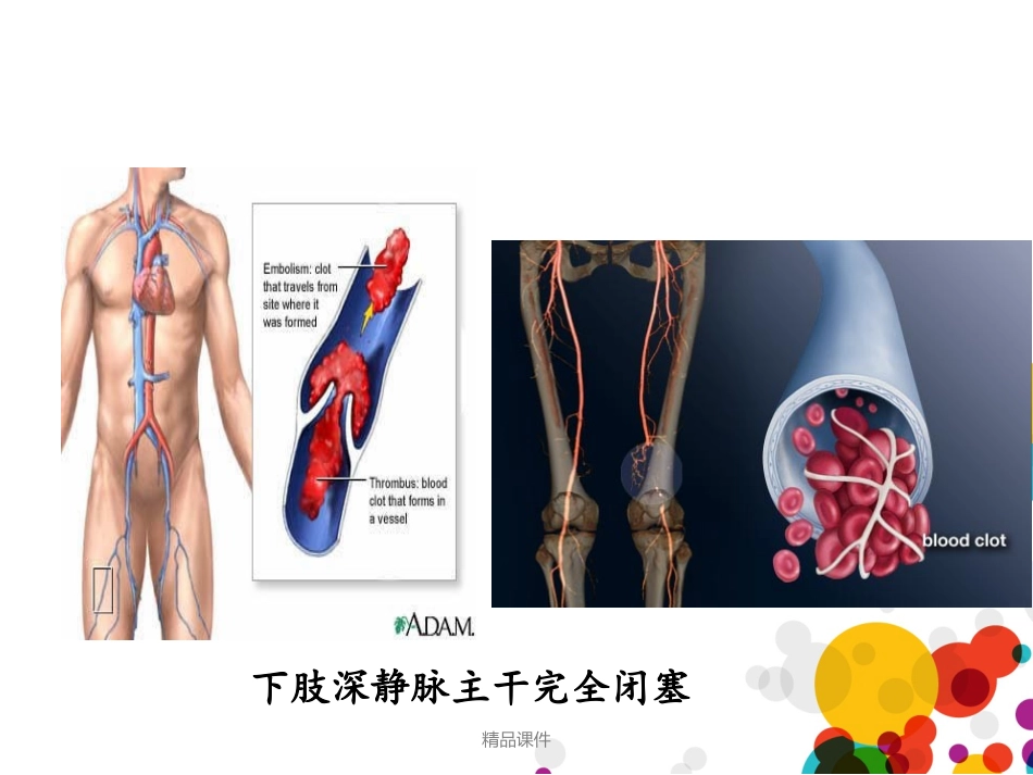 下肢深静脉血栓成稿_第3页