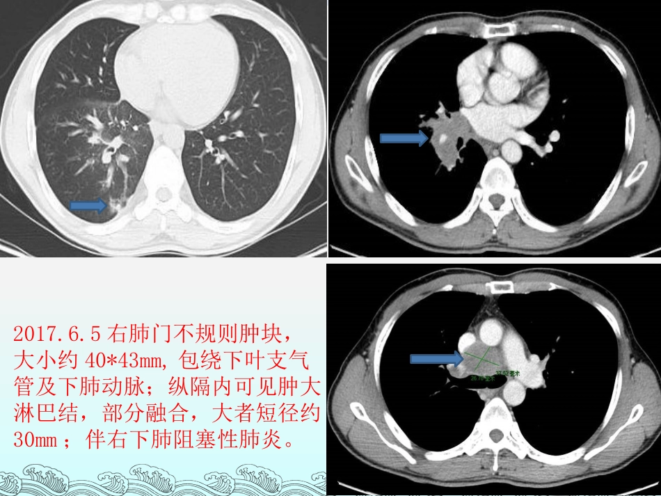 小细胞肺癌MDT病例讨论_第3页